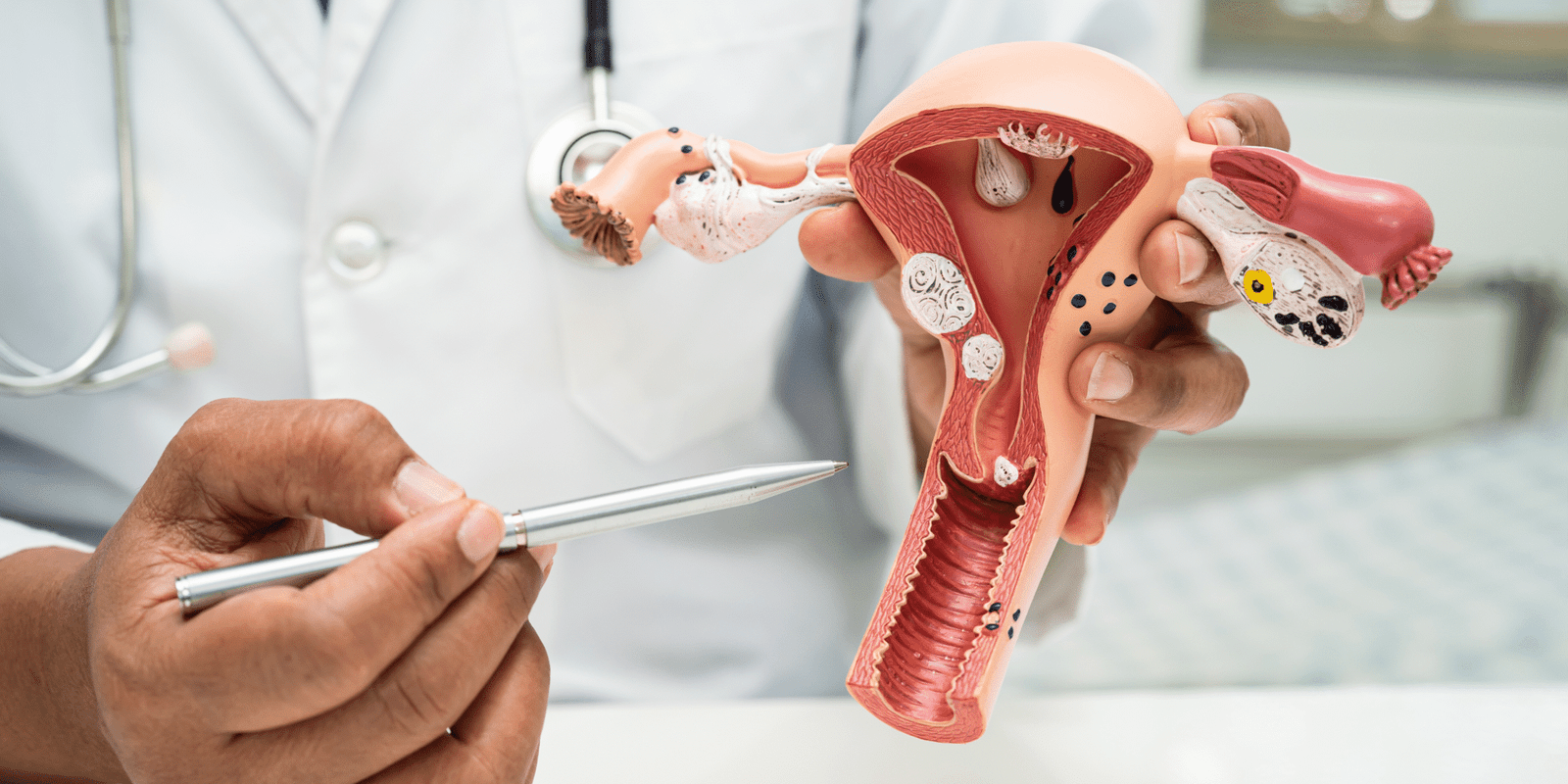 Adenomyosis