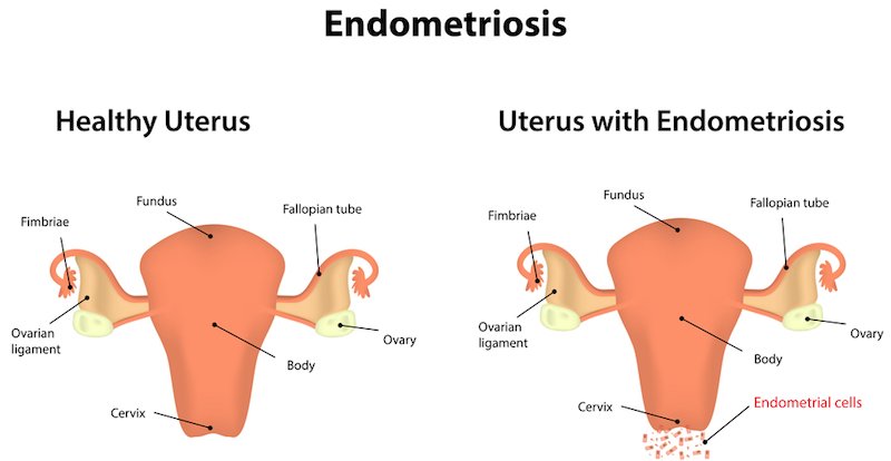 Endometriois