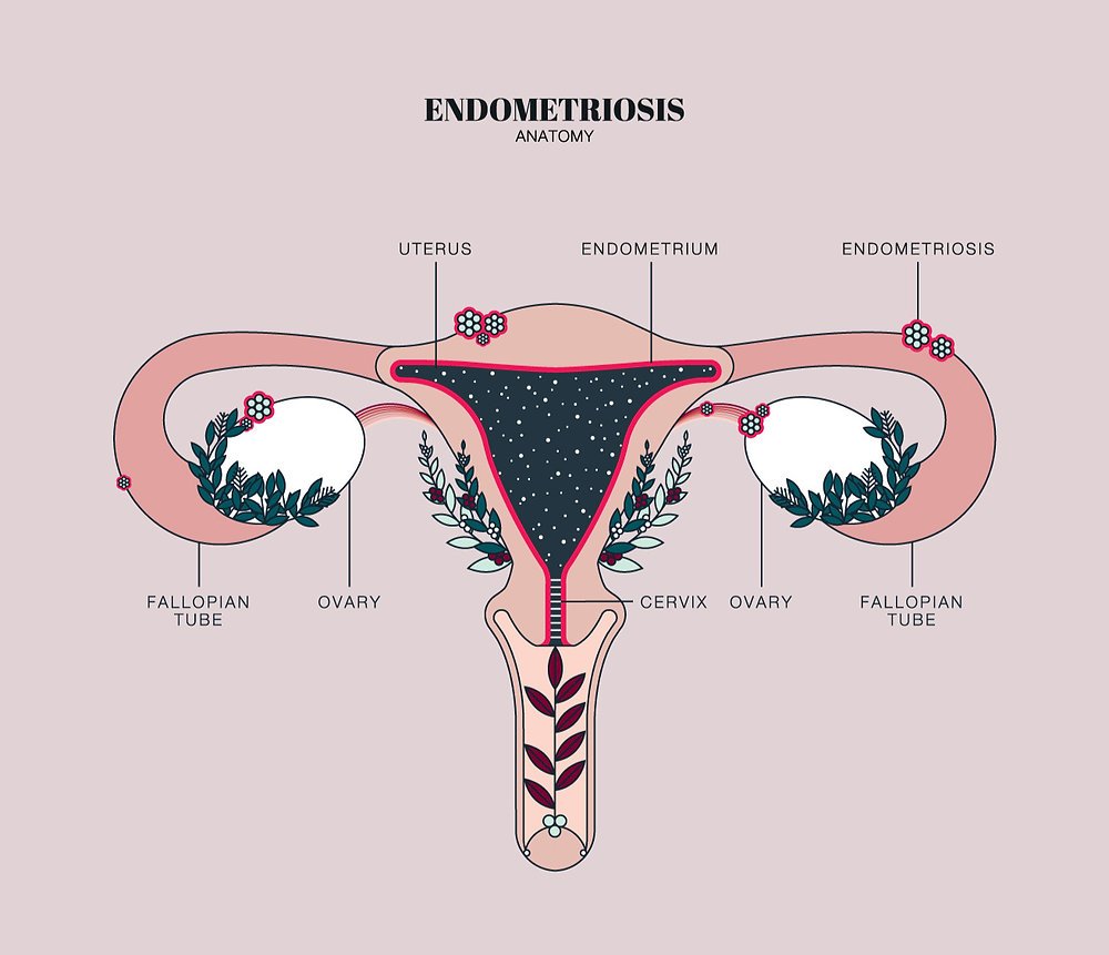 Endometriosis