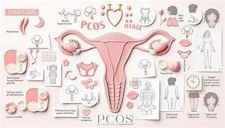 PCOS After Pregnancy