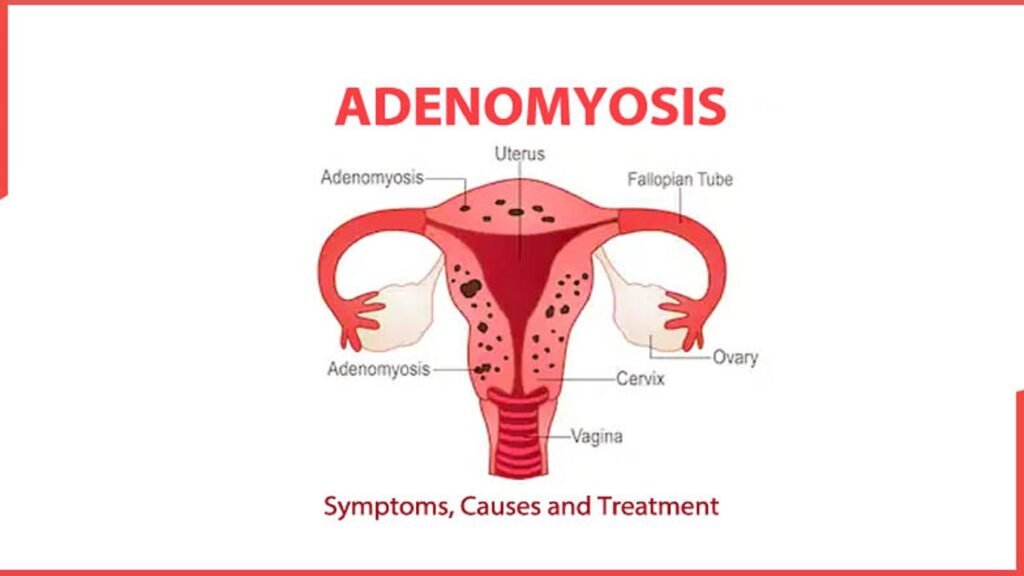 Adenomyosis