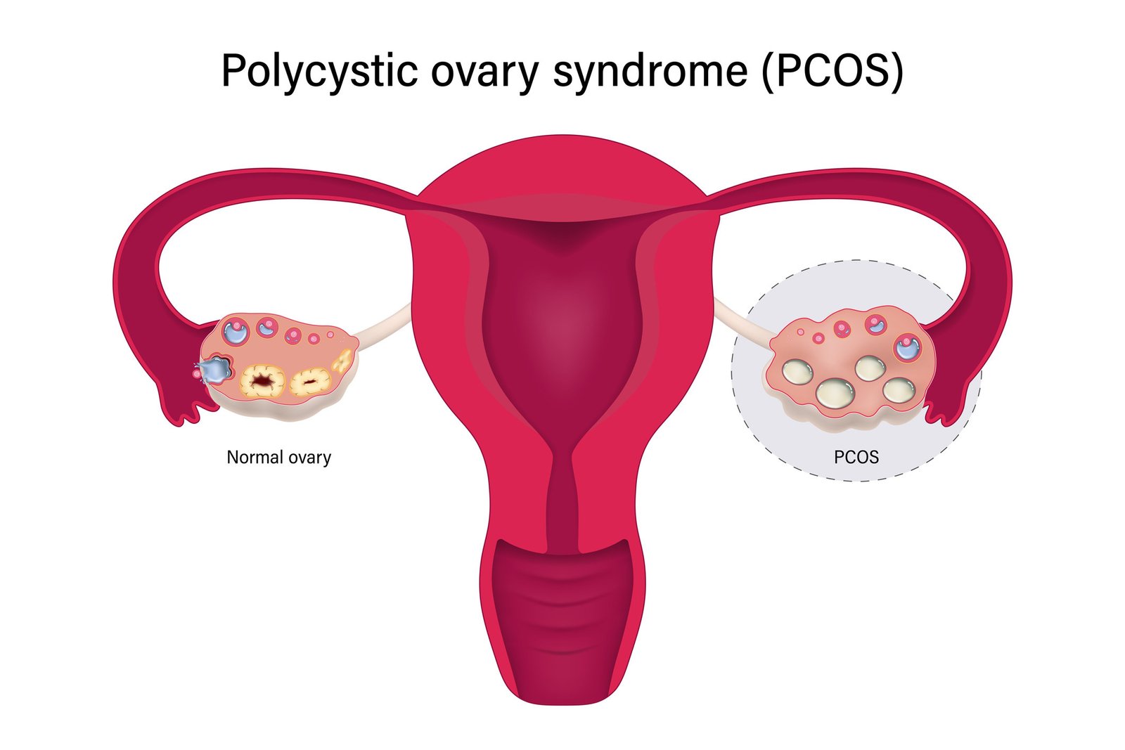 PCOS After Pregnancy