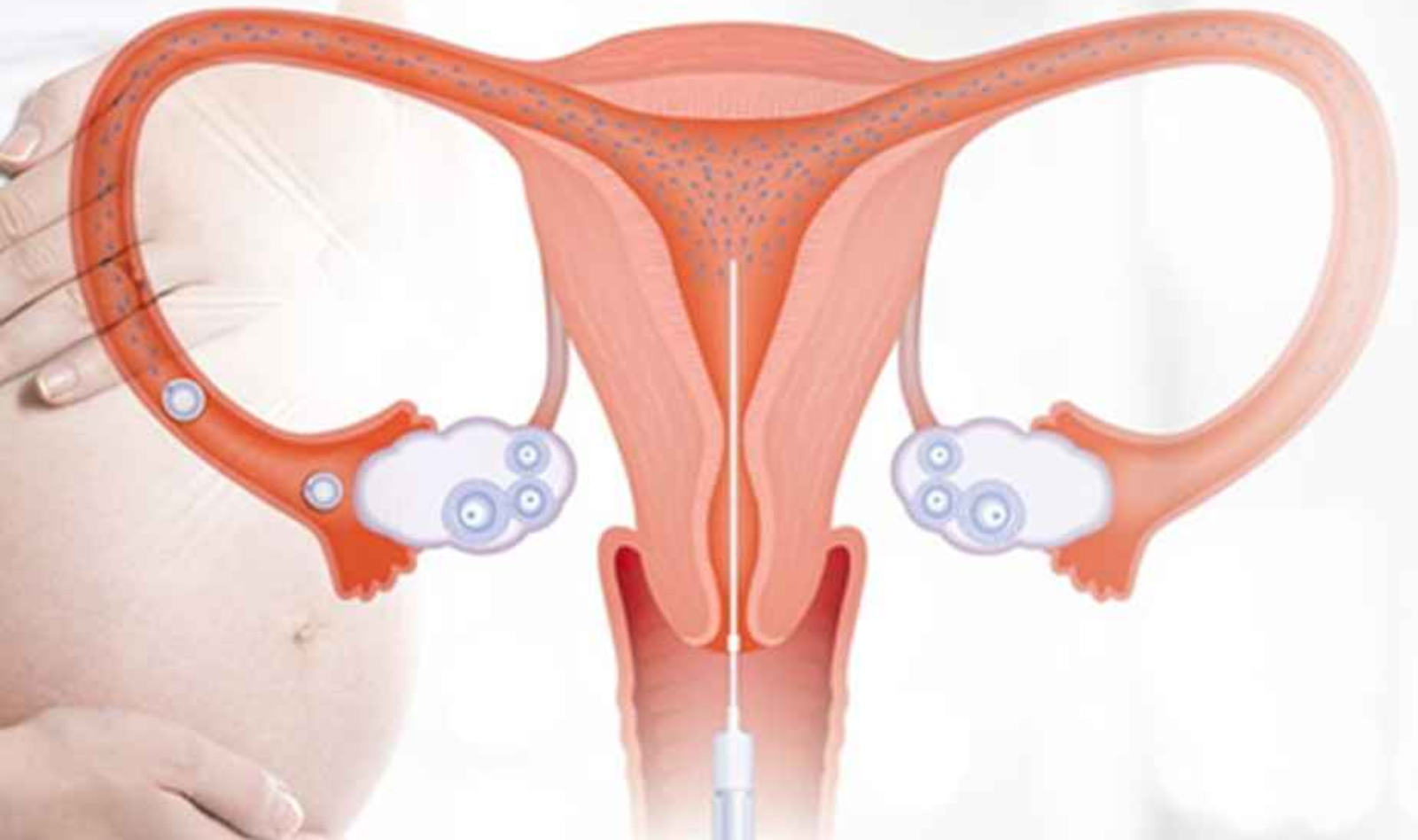 IUI Facilities Near Me